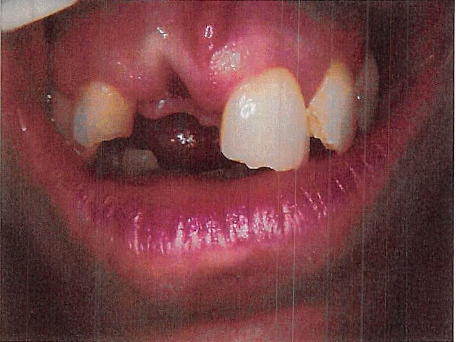 Chipped and broken teeth from scooter accident